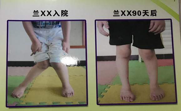 小天使康复中心典型康复病例