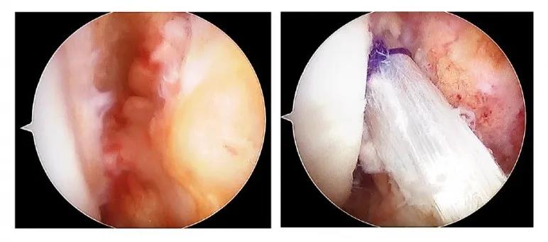 前十字韧带断裂手术