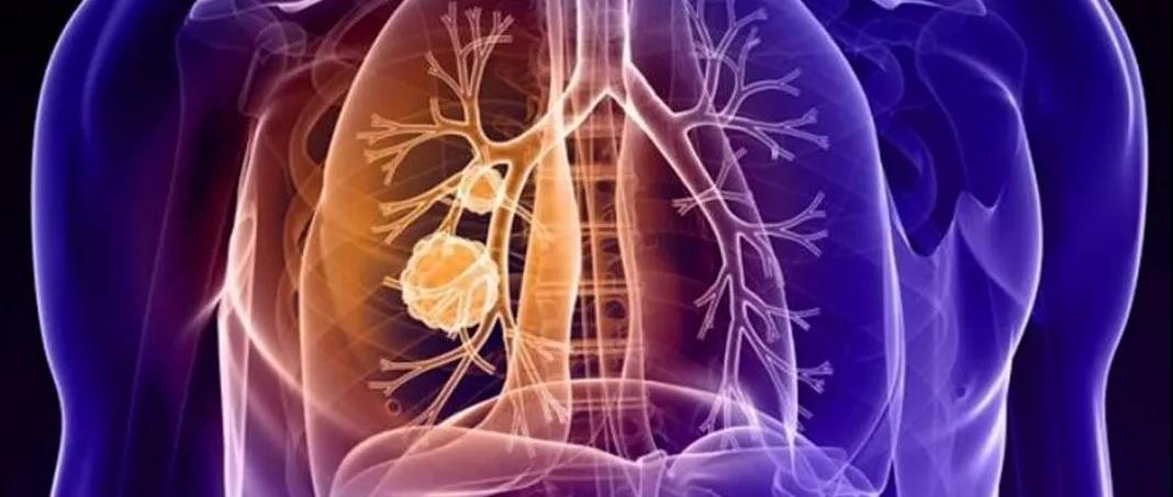 台湾长庚医院治肺癌 台湾长庚医院治肺癌