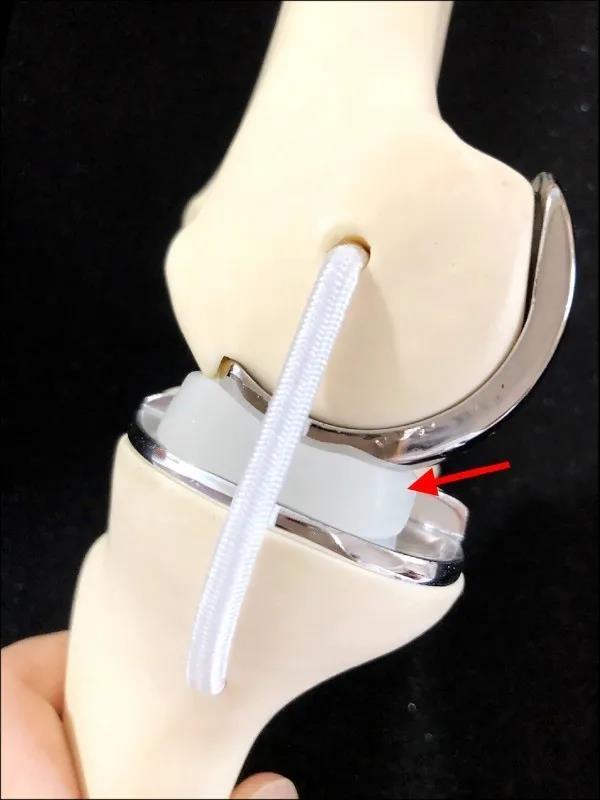 台湾长庚医院半膝关节置换手术 台湾长庚医院半膝关节置换手术