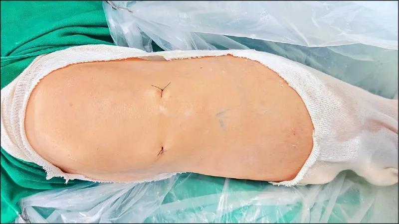 关节镜微创手术只需要两个0.5-1公分的伤口 关节镜微创手术只需要两个0.5-1公分的伤口