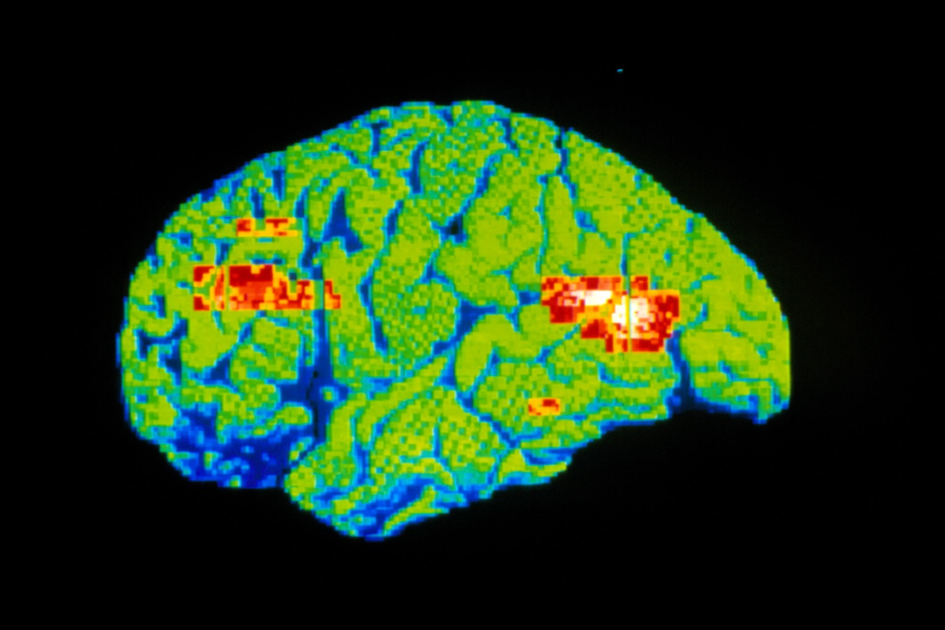新闻资讯 科学新闻   对抑郁症患者大脑的彩色正电子发射断层扫描