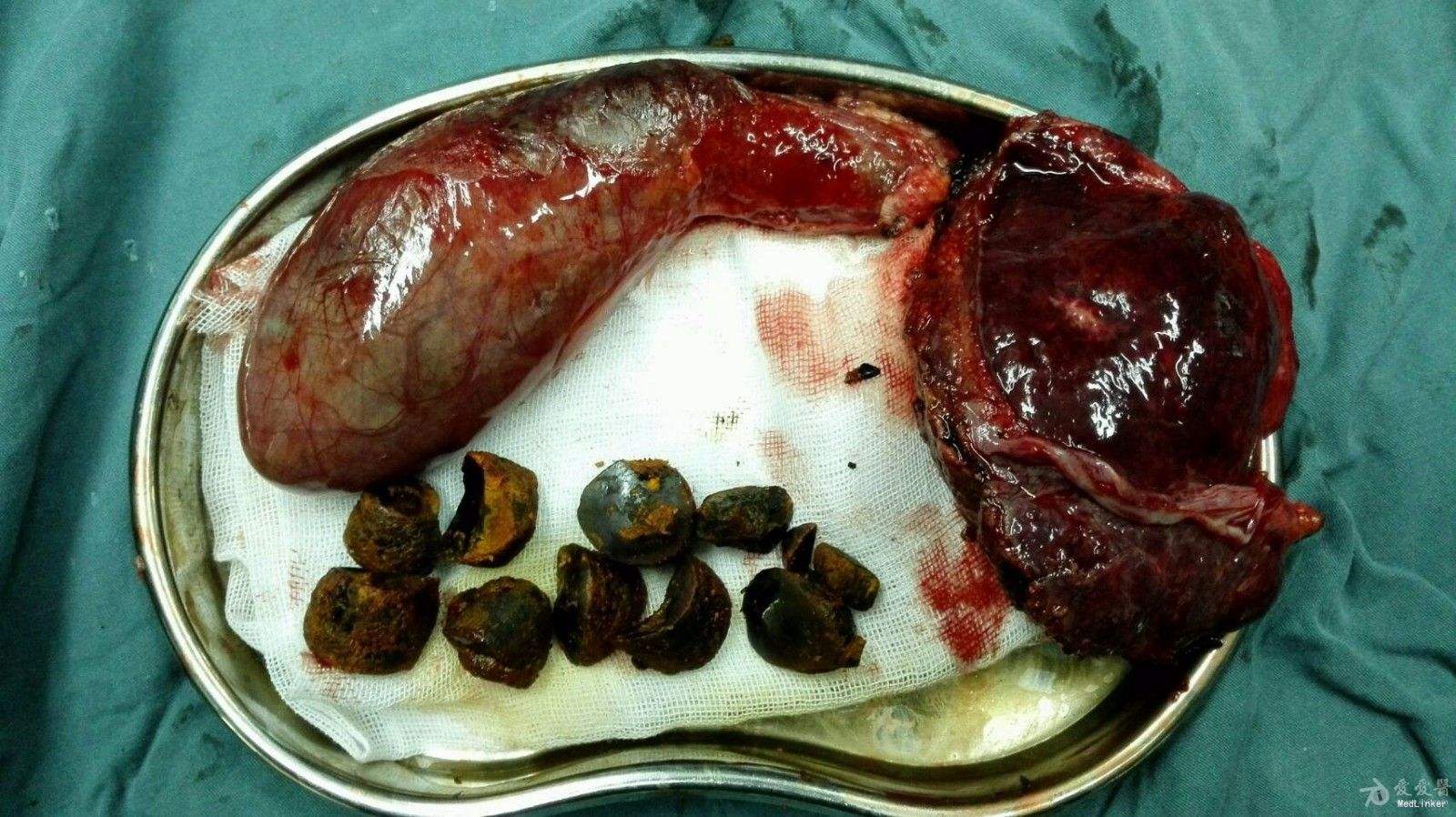 我院胆石症案例,主要危害及治疗