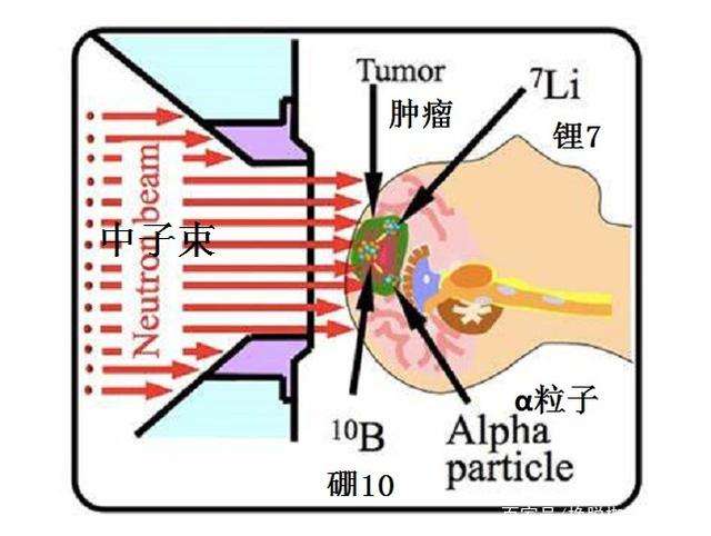 台湾硼中子捕获治疗