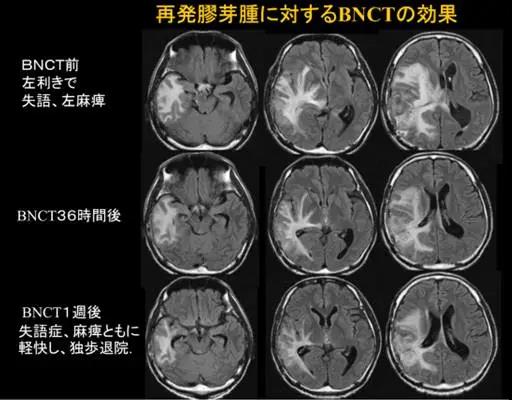 硼中子俘获疗法