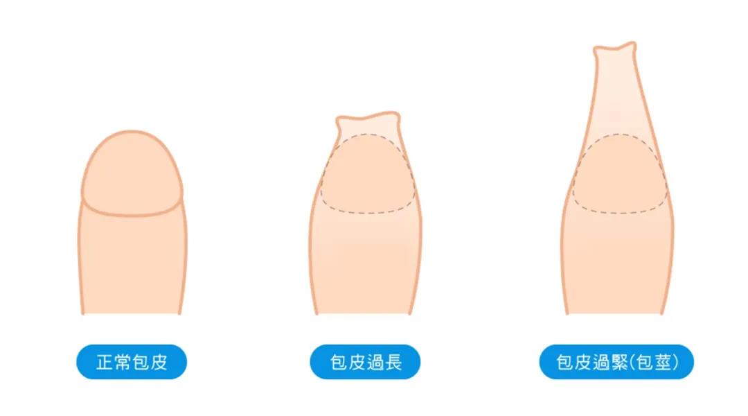【医疗科普】小朋友阴茎短小的迷思