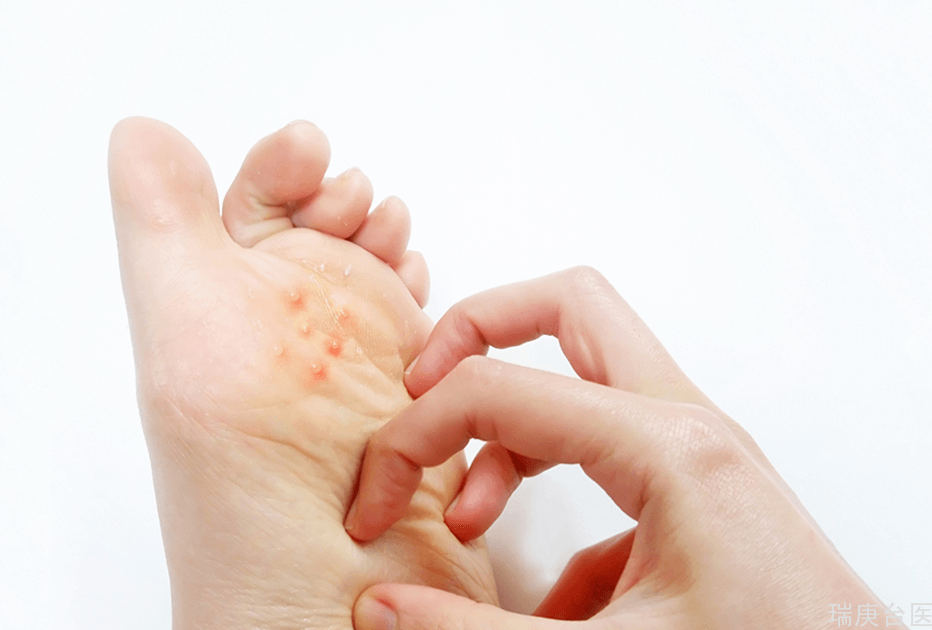 如何預防汗皰疹？皮膚科醫：愛清潔者是好發族群