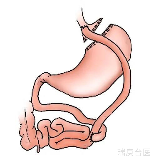 【台湾长庚医院】肥胖者六个月有效减重42斤! 减重及代谢手术