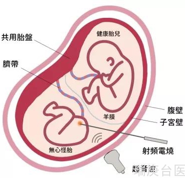 【台湾长庚医院】「射频烧灼RFA」胎内治疗：抢救同卵双胞胎中的健康孩子