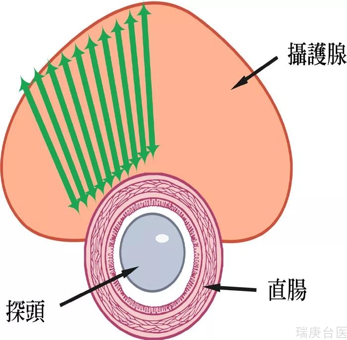 【台湾长庚医院】守护男性生命腺： 谈「海扶刀」及「冷冻疗法」在前列腺癌的应用