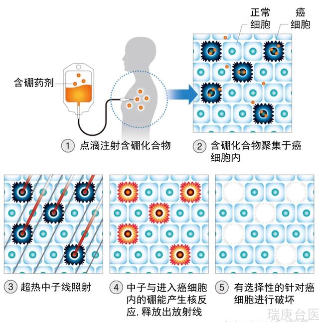 BNCT | 硼中子捕获治疗如何提高脑瘤放疗安全性