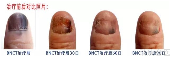 BNCT治疗黑色素瘤案例 | 治疗90天后检查未见明显异常