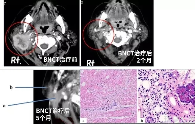 BNCT | 接受硼中子治疗的患者怎么样了？