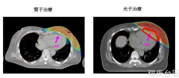 台湾长庚医院 | 乳癌新福音质子放射治疗不伤心