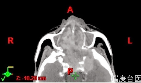 台湾长庚医院 | 质子治疗鼻咽癌肿瘤明显缩小