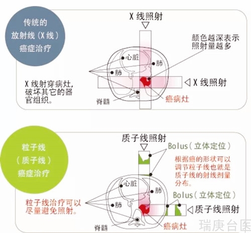 质子治疗 | 质子线可以实现准确治疗，提高癌症治疗效果！