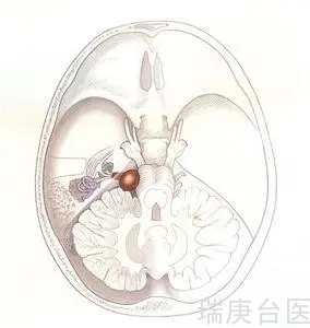 案例分享 | 颅底瘤侵蚀生命 质子治疗斩病根