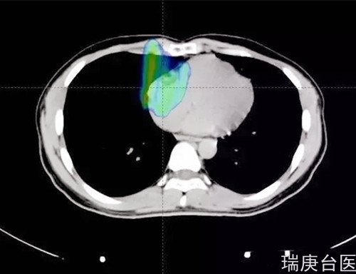 质子治疗案例 | 心脏血管肉瘤术后复发，质子治疗致肿瘤消失