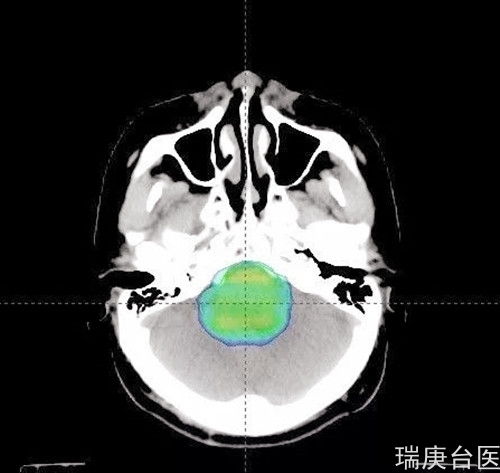 案例分享 | 质子治疗脑干胶质瘤的效果