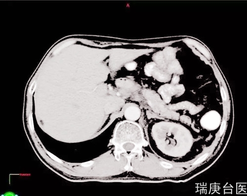 案例分享 | 食管癌腹膜后淋巴结转移 ,质子治疗肿瘤完全消失