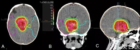 质子治疗脑膜瘤 | 肿瘤持续缩小，3年多无复发，无副作用，认知发育正常